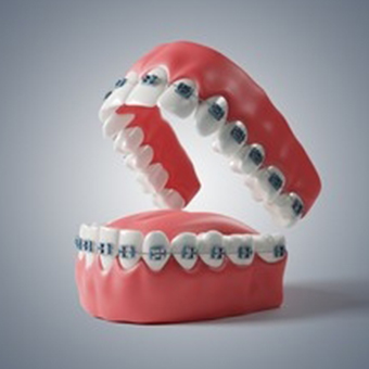 Dental Braces in karimnagar