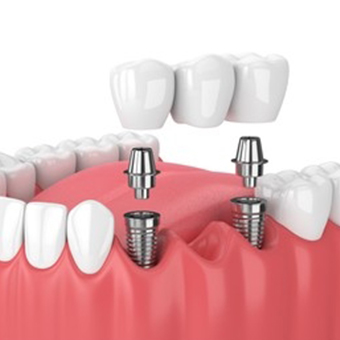 Dental Implants in karimnagar